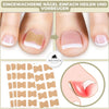 FixaNail – Correction indolore des ongles incarnés et déformés