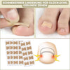FixaNail – Correction indolore des ongles incarnés et déformés