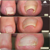 FixaNail – Correction indolore des ongles incarnés et déformés