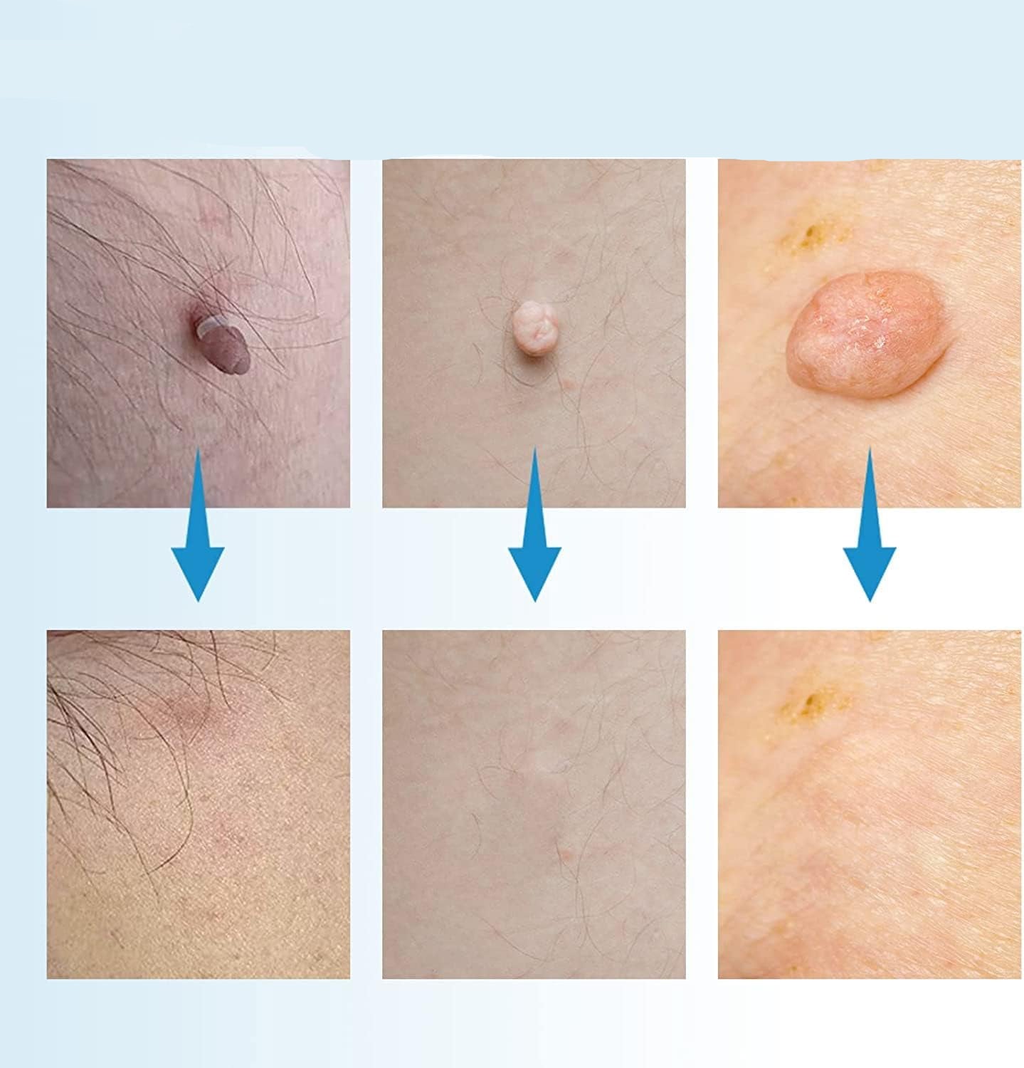 DERMASWIFT – Hautfleckenentferner gegen Warzen & Skin Tags