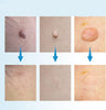 DERMASWIFT – Hautfleckenentferner gegen Warzen & Skin Tags
