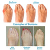 SANDALIAS ORTHOSOLE – Sandalias para Hallux Valgus para caminar sin dolor
