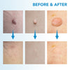 DERMASWIFT – Hautfleckenentferner gegen Warzen & Skin Tags